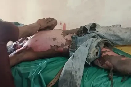 उरगा- breaking news – कोयला निकालते वक्त मजदूर हाई वोल्टेज तार की चपेट में, हालत नाज़ुक